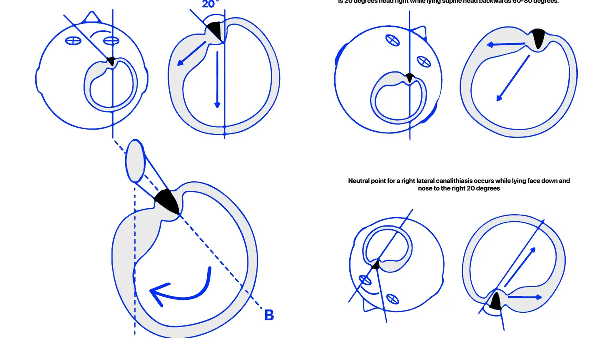 Cupulolithiasis