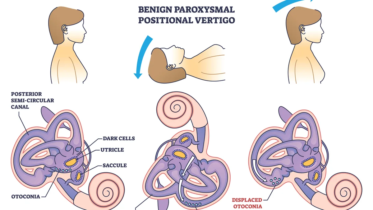 Benign Paroxysmal Positional Vertigo (BPPV)