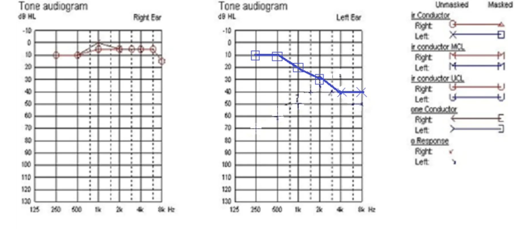 Migraine Variant